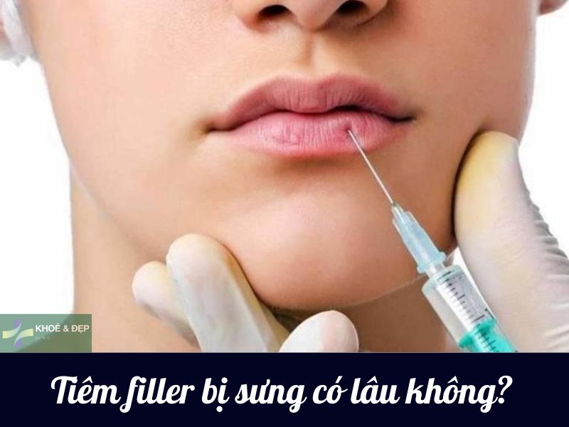 Tiêm filler bị sưng có lâu không?