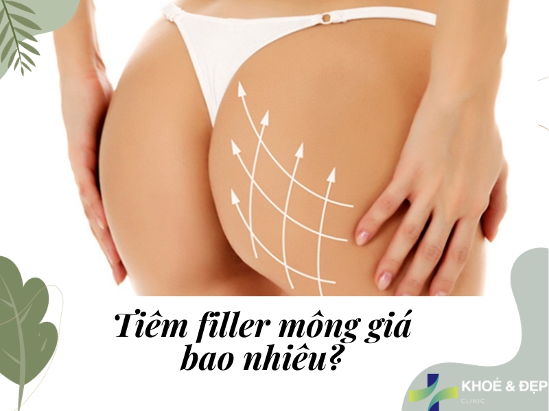 Tiêm filler mông giá bao nhiêu?