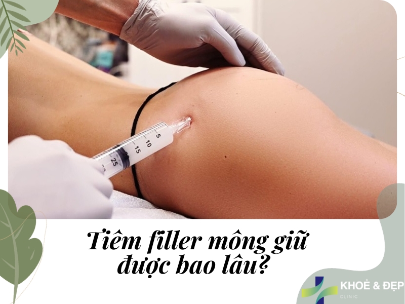 Tiêm filler mông giữ được bao lâu?