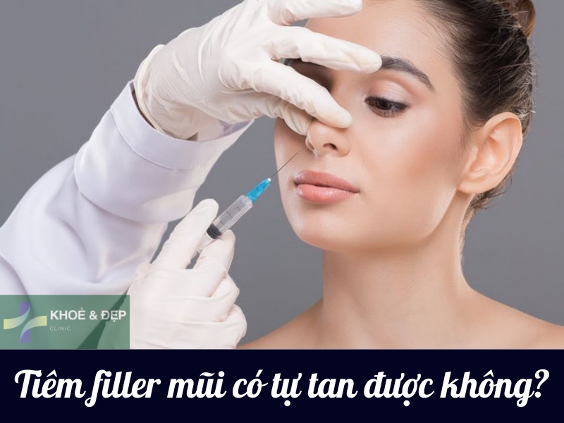 Tiêm nâng mũi có tự tan được không?