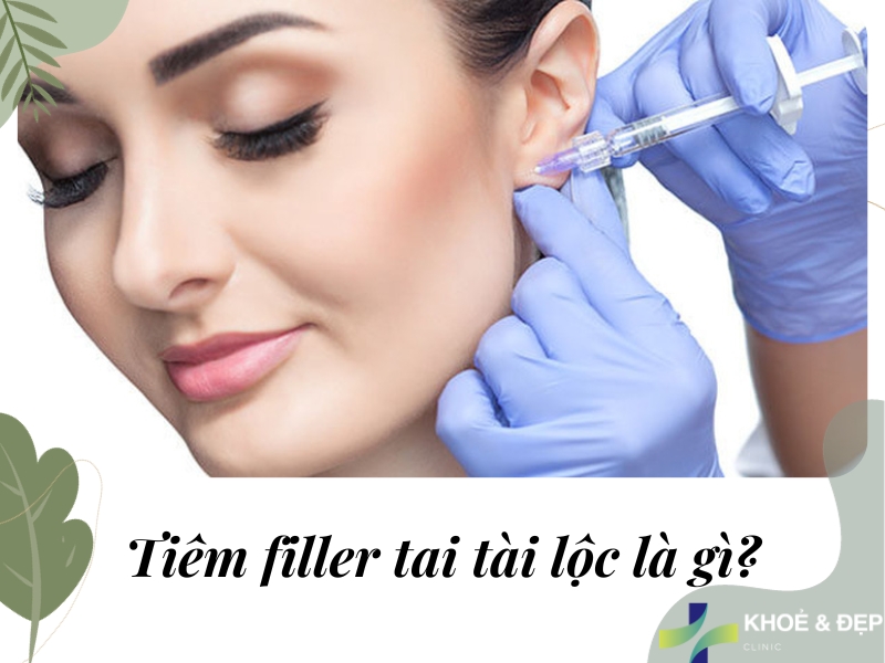 Tiêm filler tai tài lộc là gì?