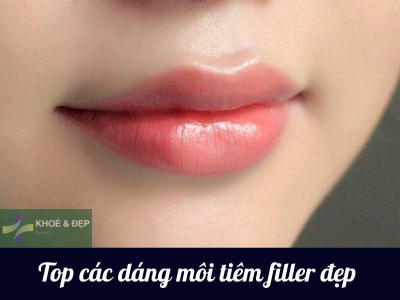 Các dáng môi tiêm filler đẹp nhất 2024