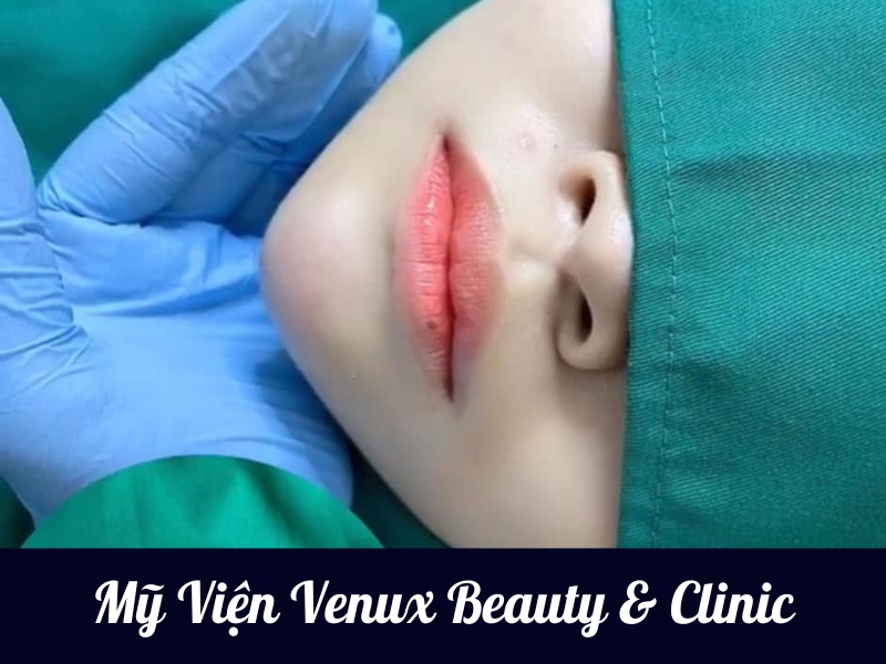 Mỹ Viện Venux Beauty & Clinic- Địa chỉ tiêm filler tại Buôn Ma Thuột