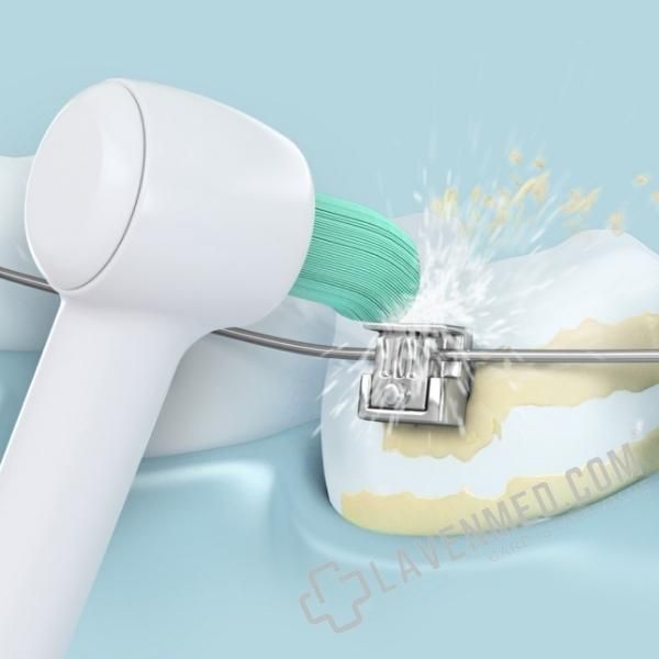 Cách làm sạch răng và mắc cài của đầu tăm chuyên dụng