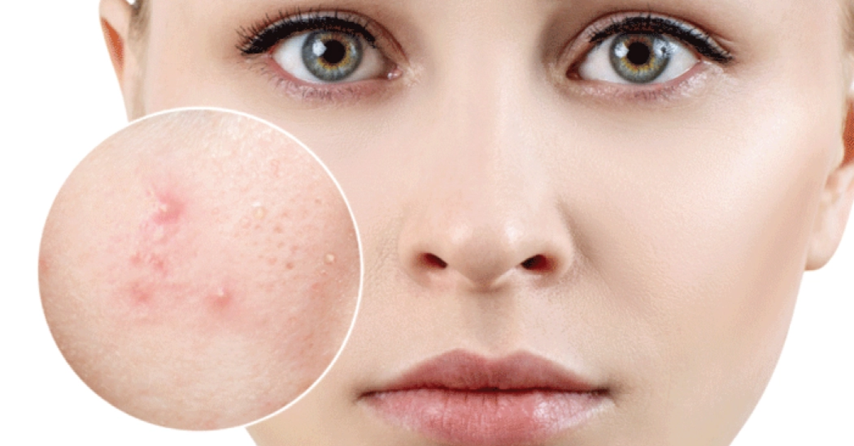 Kem chống nắng Skin Aqua màu hồng không phù hợp cho da có nhiều mụn đỏ