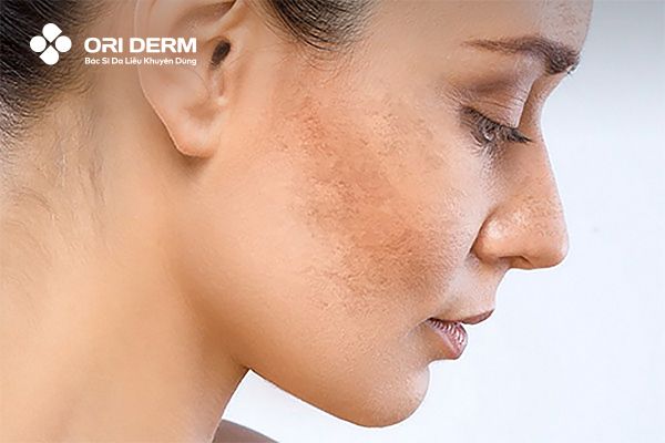 Những ai nên áp dụng phương pháp thay da sinh học?