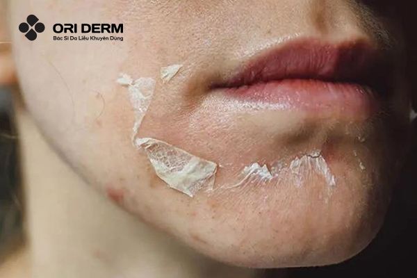 Lưu ý chăm sóc da sau khi peel da trị thâm