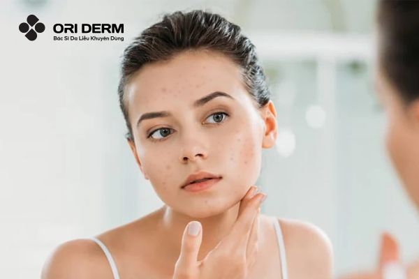 Da mụn có nên tẩy tế bào chết không?