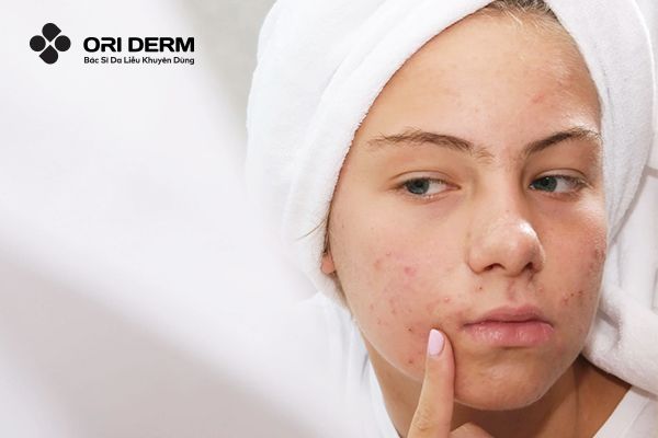 Cách lựa chọn sữa rửa mặt với từng loại da cho tuổi dậy thì