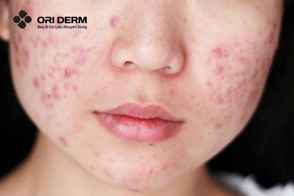 Nguyên nhân gây mụn viêm đỏ ngứa