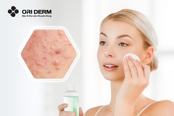 10 Toner Cho Da Dầu Mụn Có Khả Năng Làm Dịu Da Và Giảm Mụn Hiệu Quả