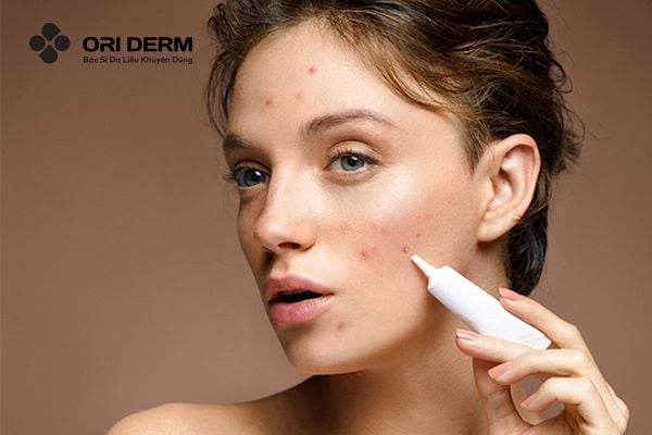 Cách chọn kem trị mụn nội tiết an toàn và hiệu quả