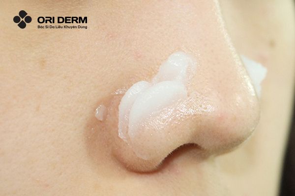 Điều trị mụn ẩn ở mũi bằng Retinol