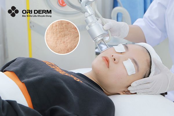 Trị Sẹo Rỗ Bằng Laser Có Hiệu Quả Không? Ưu Điểm Và Nhược Điểm