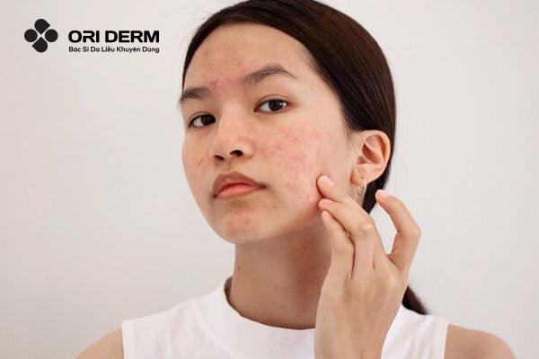 Đặc điểm và nguyên nhân gây tình trạng da mụn nhạy cảm