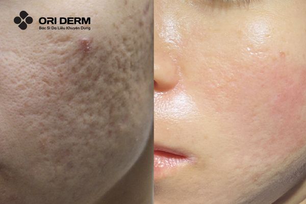 Tác dụng của trị sẹo rỗ bằng Laser CO2