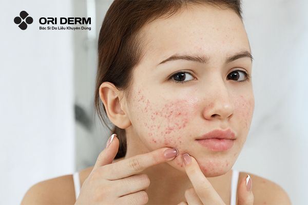Nguyên Nhân Và Cách Khắc Phục Da Mặt Bị Break Out