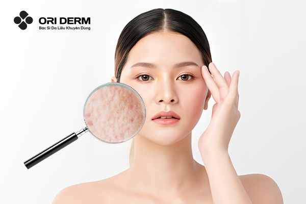 Sẹo Đáy Tròn Là Gì? Nguyên Nhân Và Cách Cải Thiện Hiệu Quả