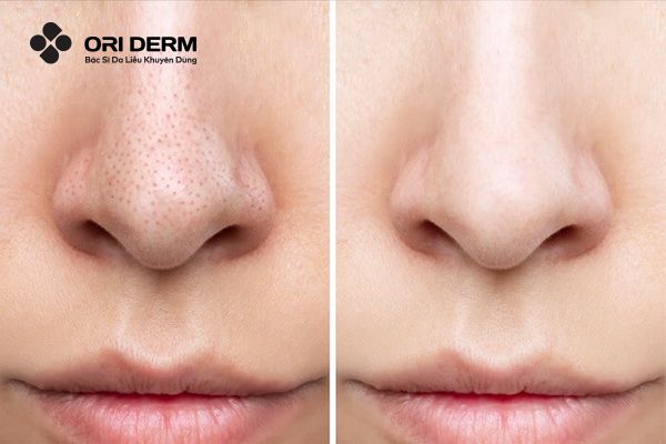 Gợi ý 5 cách triệt mụn đầu đen ở mũi hiệu quả