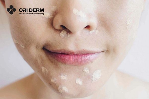 Bôi kem trị mụn