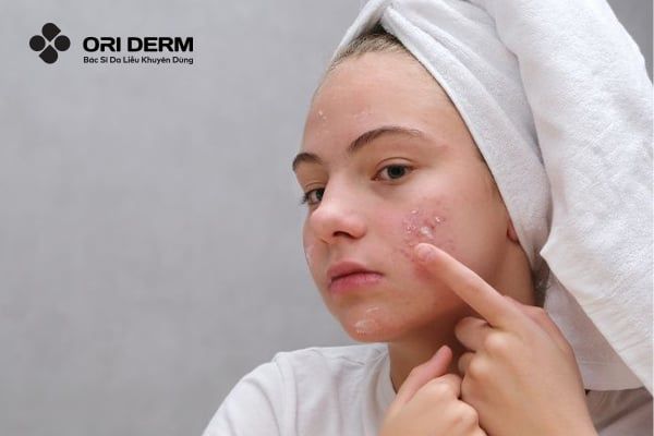 Bôi thuốc trị mụn tại chỗ