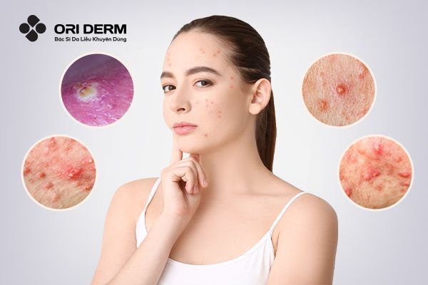 Các loại mụn viêm thường gặp