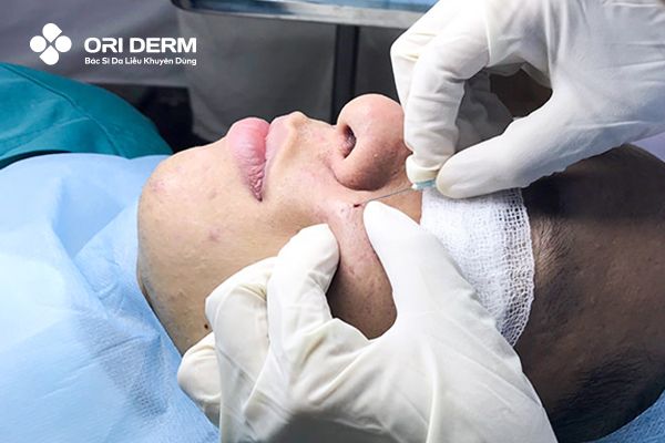 Cắt đáy sẹo làm mờ sẹo rỗ đáy tròn