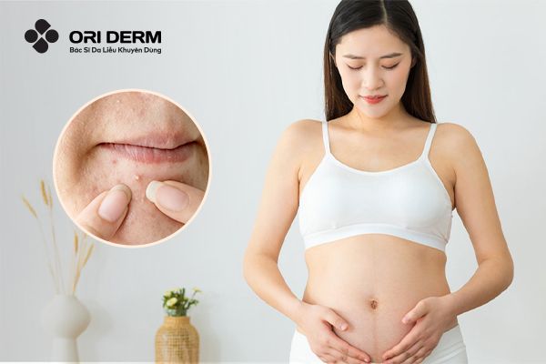 Mang Bầu Nặn Mụn Được Không? Tìm Hiểu Cách Chăm Sóc Da Mụn Cho Bà Bầu