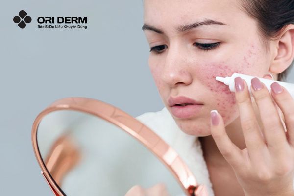 Cách xử lý khi mặt bị break out