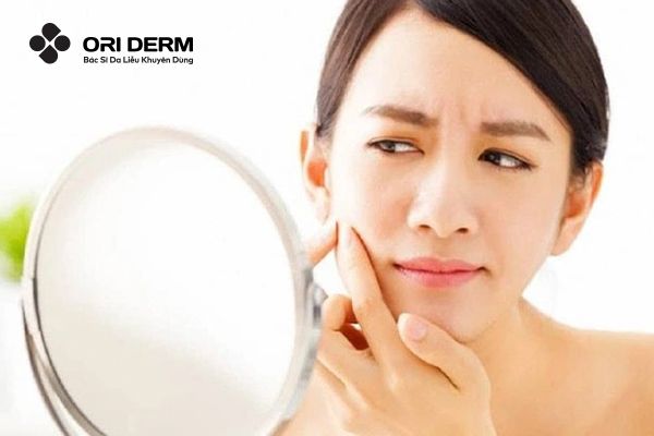 Có nên nặn mụn sưng viêm không nhân?