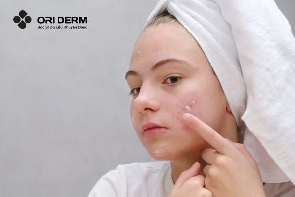 Công dụng của kem trị mụn