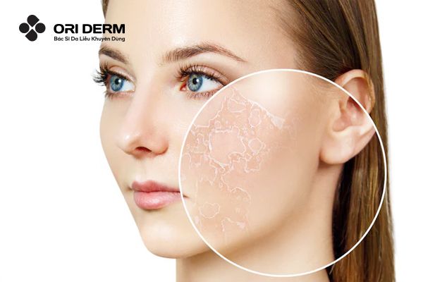 Da khô là gì? Nguyên nhân gây khô da