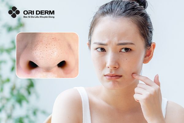 Tổng Hợp Cách Trị Mụn Đầu Đen Ở Mũi An Toàn Và Hiệu Quả