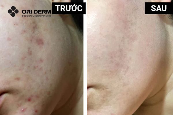 Tác dụng của Niacinamide đối với thâm mụn