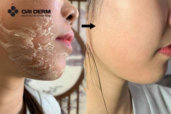 Thay da sinh học là gì?