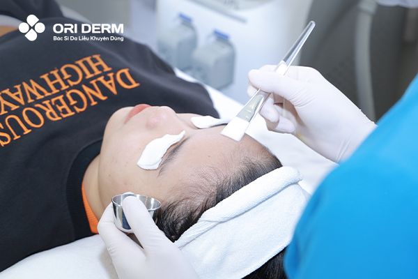 Peel da trị mụn đầu đen mũi