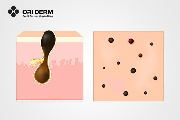 Nguyên nhân gây mụn đầu đen ở mũi