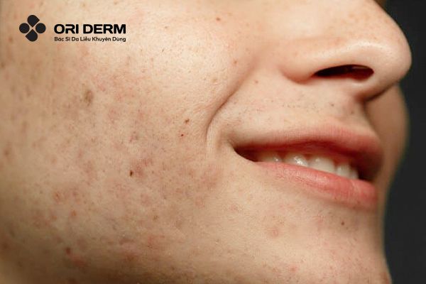 Vì Sao Sau Khi Peel Da Bị Thâm? Cách Phục Hồi Da Bị Thâm