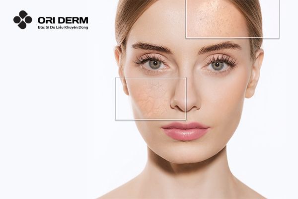 Cách nhận biết da hỗn hợp thiên khô