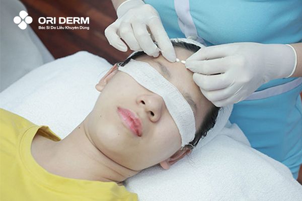 Nặn mụn là gì? Có tốt không theo góc nhìn của các chuyên gia