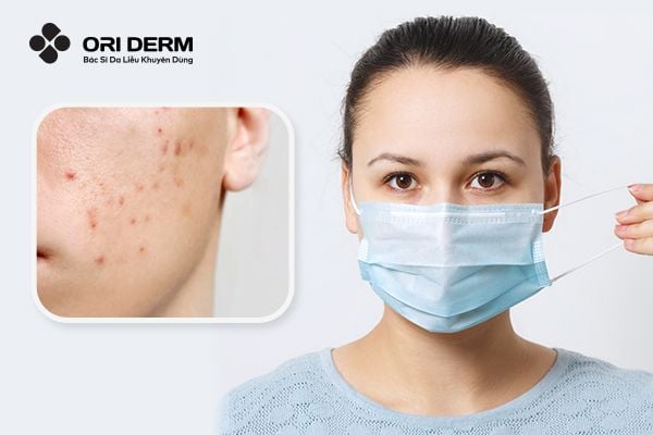 Nguyên Nhân Và Cách Khắc Phục Khi Đeo Khẩu Trang Bị Mụn