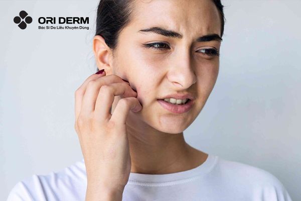 Khi bị mụn viêm đỏ ngứa cần lưu ý điều gì?