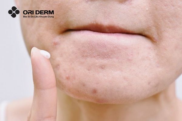 Lưu ý khi sử dụng sản phẩm trị mụn ẩn
