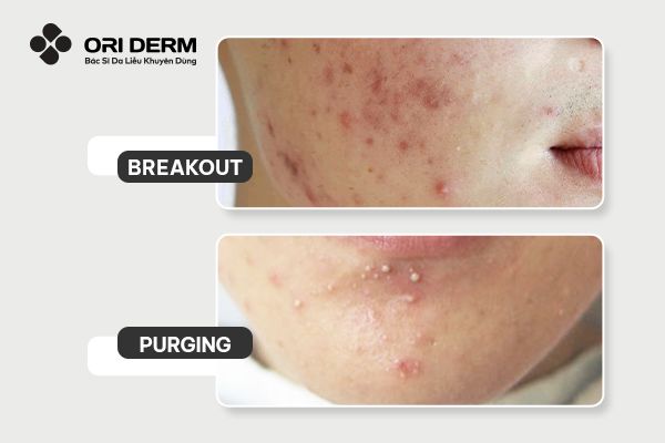 Sự khác biệt giữa Break out và Purging