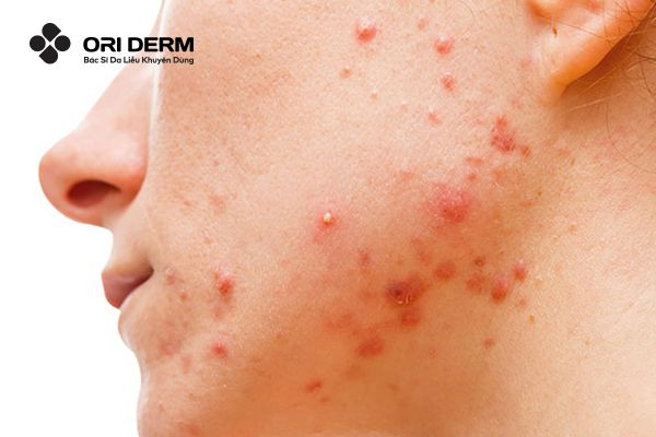 Mụn nội tiết là gì? Các mức độ của mụn nội tiết