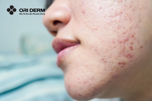 Break out là gì trong chăm sóc da?