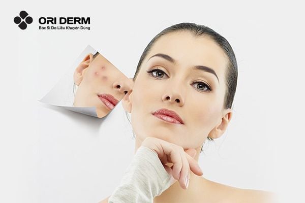 Tổng hợp 08 Sản Phẩm Kem Trị Mụn Nội Tiết Hiệu Quả, Cho Da Láng Mịn