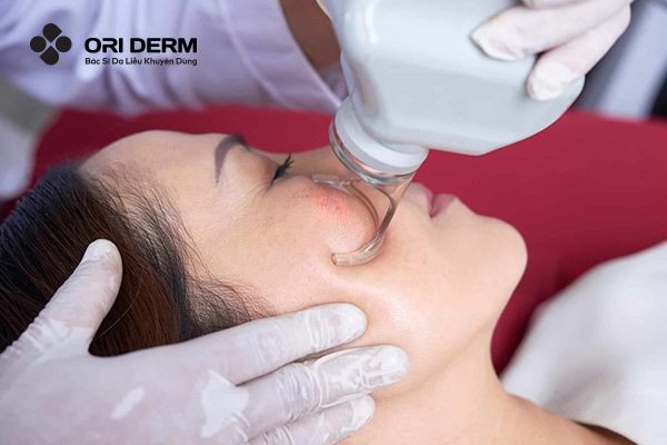 Laser trị sẹo rỗ là gì?