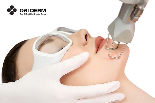 Laser trị sẹo mụn