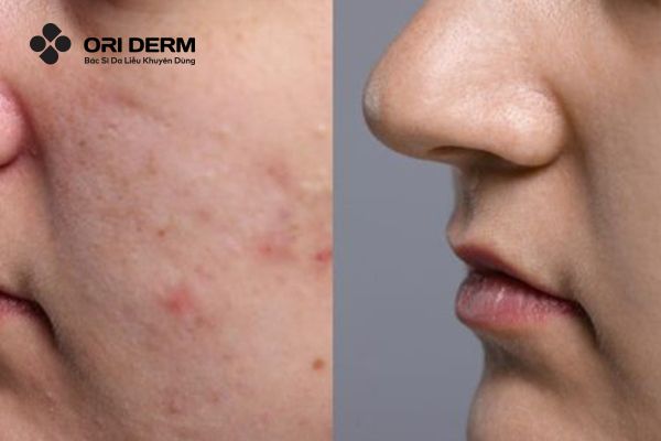 Lợi ích của peel da trị thâm